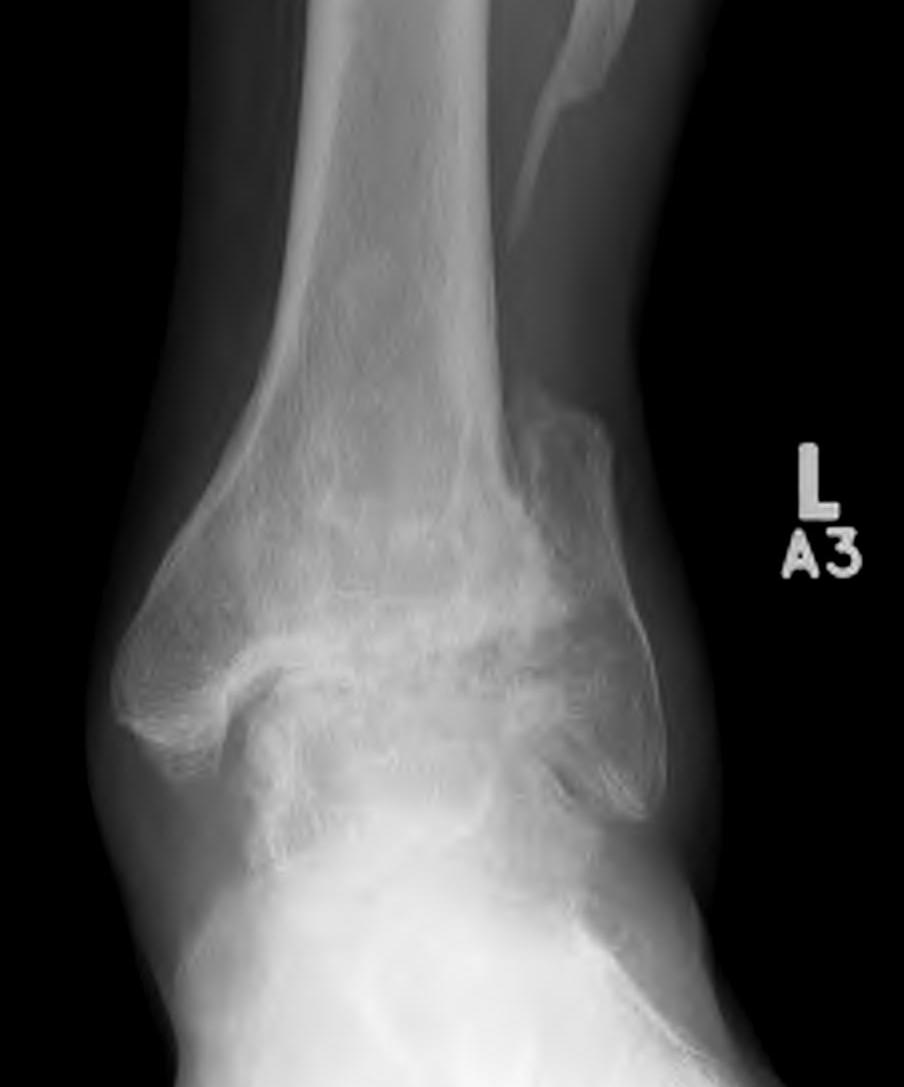 Ankle OA AP Xray